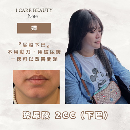 下巴玻尿酸