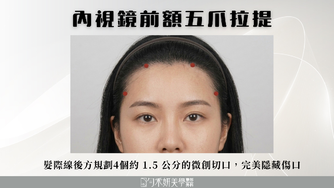 內視鏡前額五爪拉提